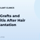 Buried Grafts and Folliculitis After Hair Transplantation