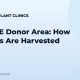 The FUE Donor Area: How Follicles Are Harvested