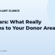 FUE Scars: What Really Happens to Your Donor Area