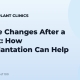 Hairline Changes After a Facelift: How Transplantation Can Help