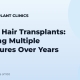 Staged Hair Transplants: Planning Multiple Procedures Over Years