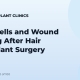 Stem Cells and Wound Healing After Hair Transplant Surgery