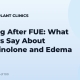 Swelling After FUE: What Reviews Say About Triamcinolone and Edema