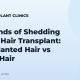 Two Kinds of Shedding After a Hair Transplant: Transplanted Hair vs Native Hair
